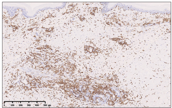 Immunohistochemistry showed positive staining for CD8 of atypical cells (100x).